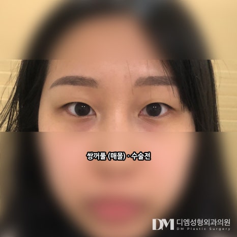 쌍꺼풀수술, 내 눈매에 맞는 자연스러운 라인으로 관련 이미지 10