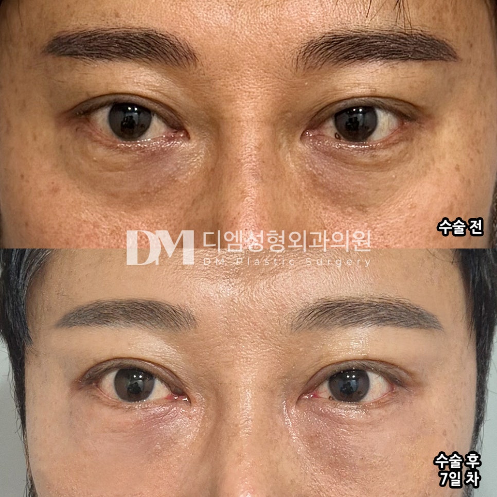 눈밑지방재배치 후기."통증도 없고 만족합니다 !!" 관련 이미지 2