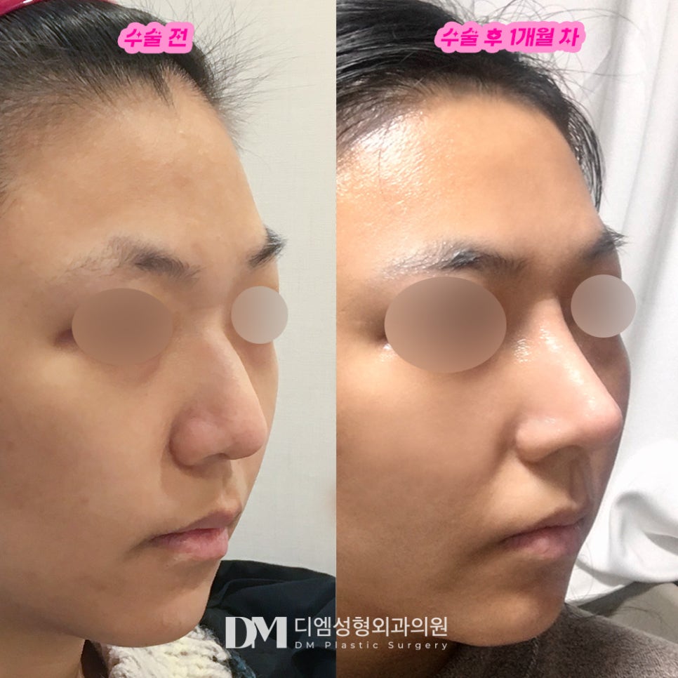 Hump Nose Surgery: Improving Both Appearance and Internal Function! image 6