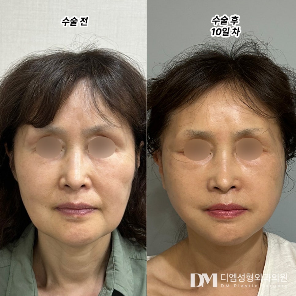 안면거상, 잃어버린 자신감 되찾기 ! 관련 이미지 6