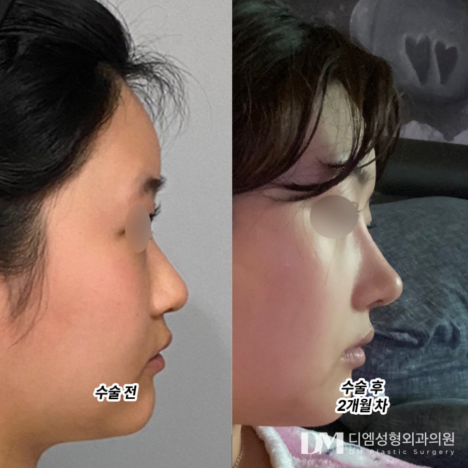 Rhinoplasty Review. “Everyone around me says I’m pretty, I’m so happy these days!” image 2