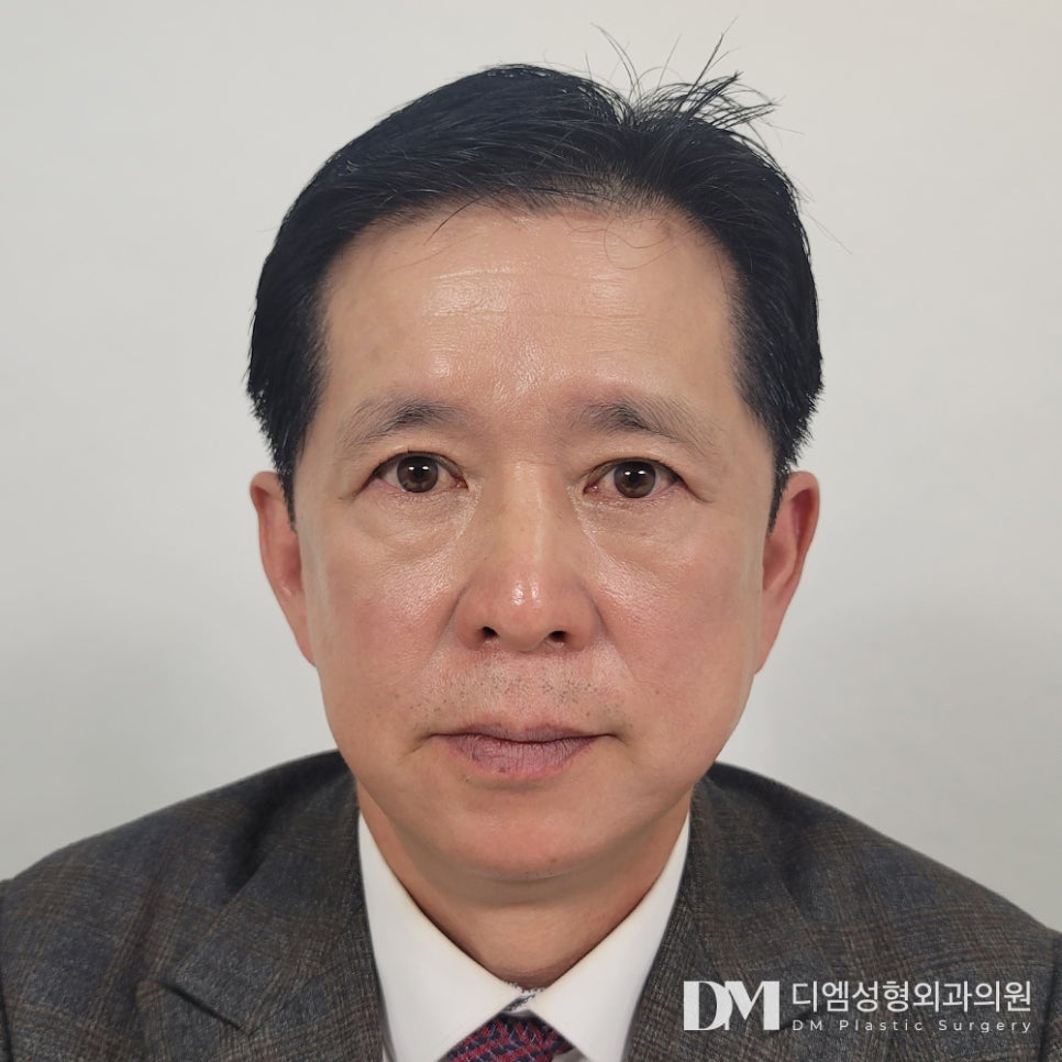 상안검, 처져 답답해 보이는 눈매 개선하기 관련 이미지 14