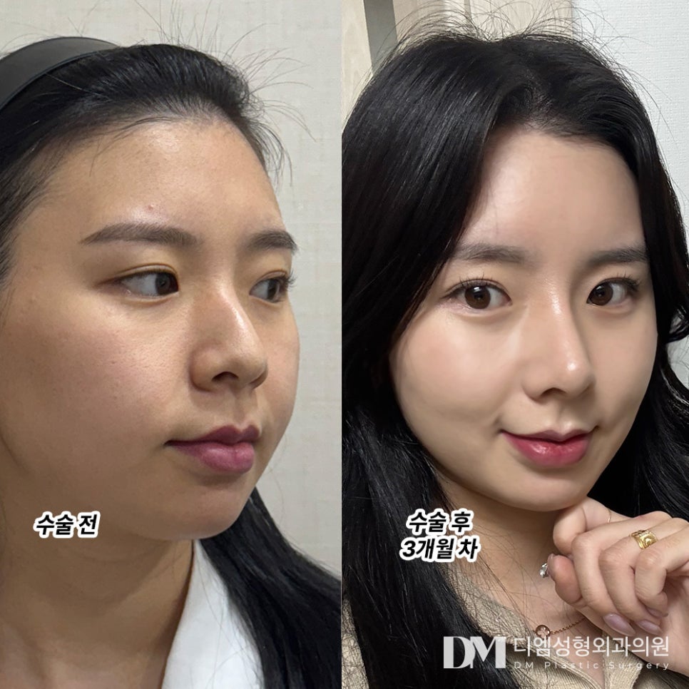 Plastic Surgery Review. "Exactly the Nose Bridge I Wanted, and I’m So Satisfied with the Fat Grafting!" image 2