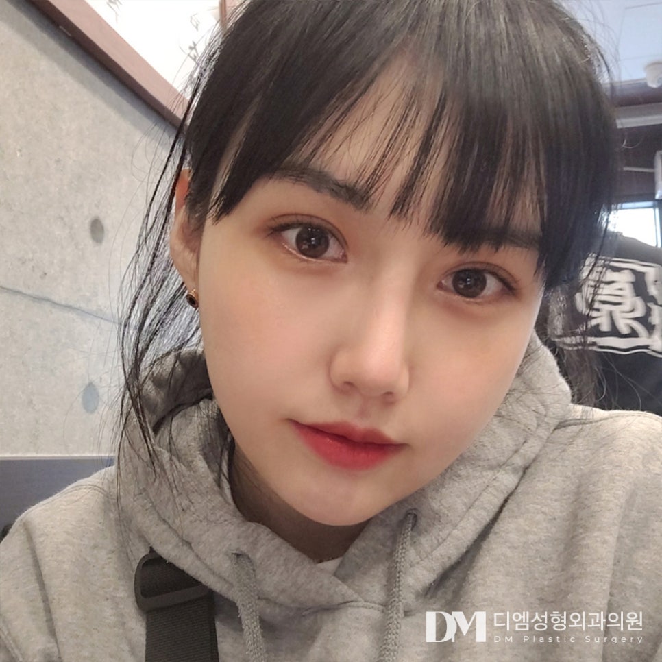 Eye-Shape Correction Combined with Double-Eyelid Surgery for More Defined Eyes! image 16
