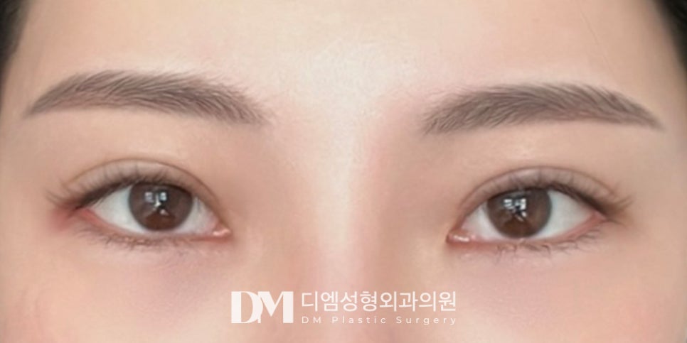Want to Look Naturally More Beautiful with Double-Eyelid Surgery for the New Year? image 8