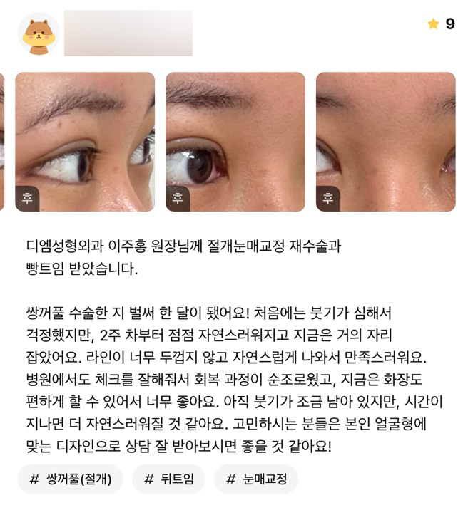 눈성형 후기."라인이 너무 두껍지 않고 자연스럽게 나와서 만족스러워요" 관련 이미지 1