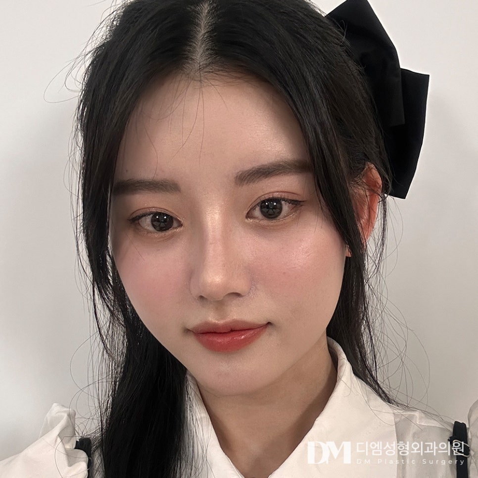 복코성형, 동글동글 뭉툭한 코 개선하려면 관련 이미지 1