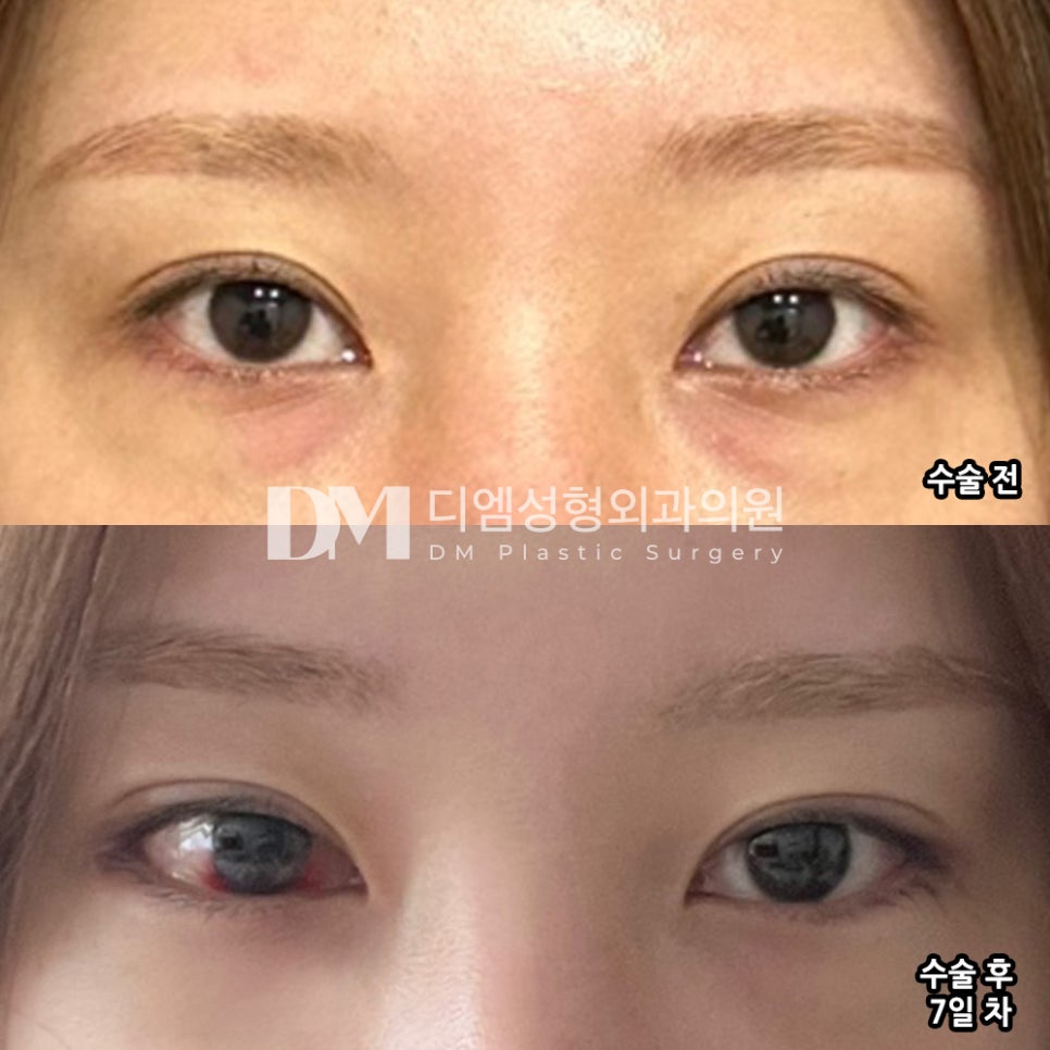 빵트임 후기."답답했던 눈이 제가 원하는 시원한 눈으로 바뀌었어요!" 관련 이미지 2