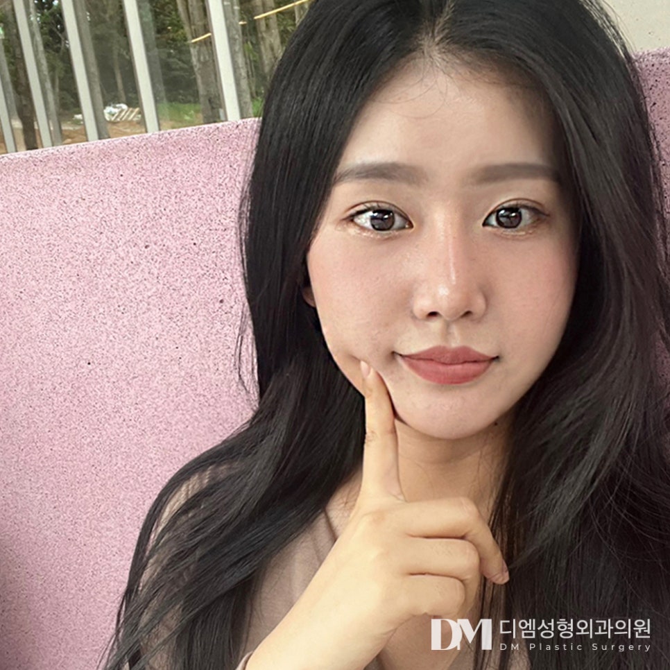 디엠 눈밑지방재배치 전후사진, 화장으로 가려지지 않는 눈 밑 개선 완료! 관련 이미지 1