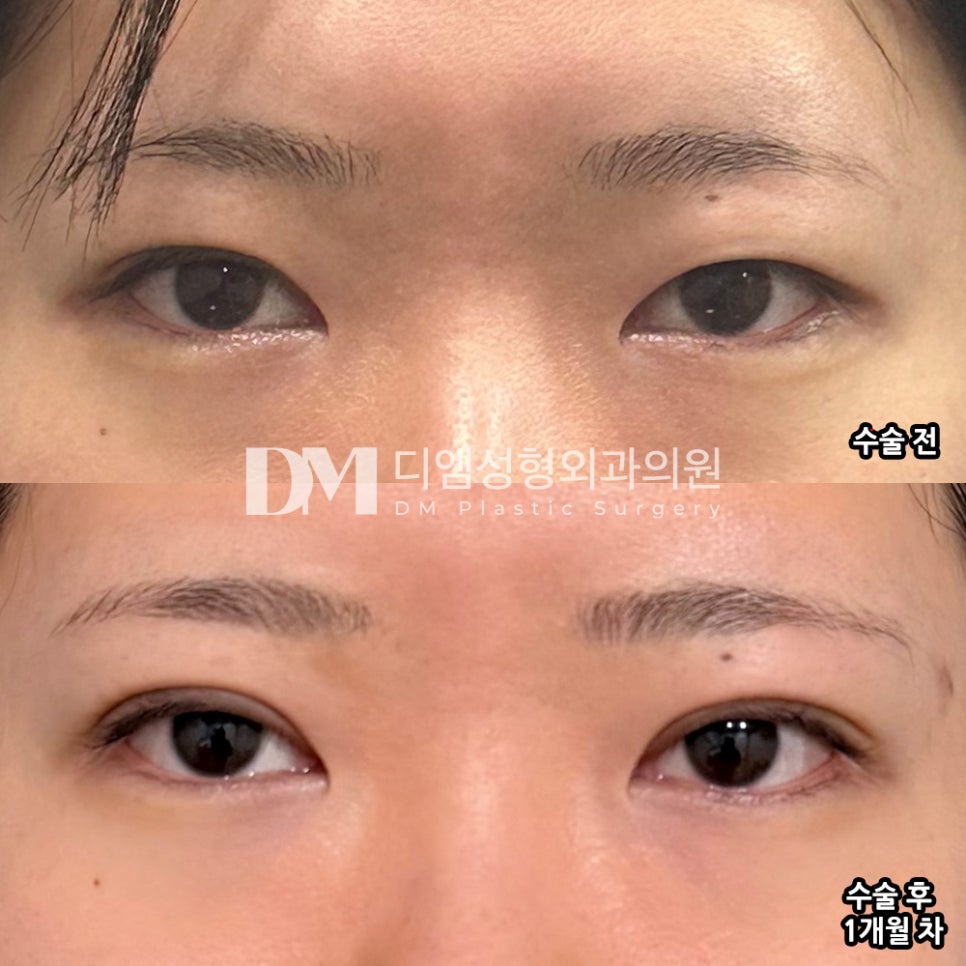 Revision Eyelid Surgery Review. "If I need another surgery later, I want to go there again!" image 2