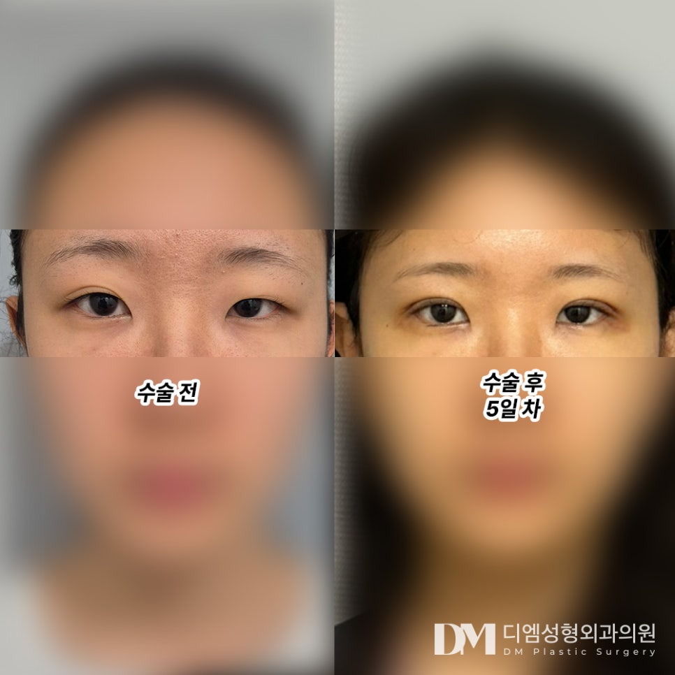 Review of Eye Revision Surgery. "Even though the swelling hasn't gone down much yet, I'm satisfied because it turned out the way I wanted!" image 2