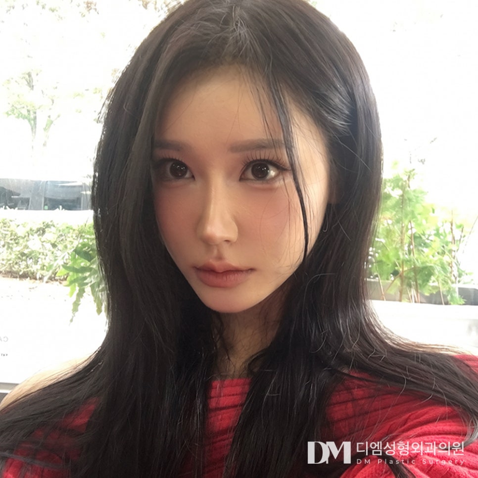 디엠 트임성형 전후사진, 앞과 뒤가 답답해 보이는 눈매 개선 방법은? 관련 이미지 1