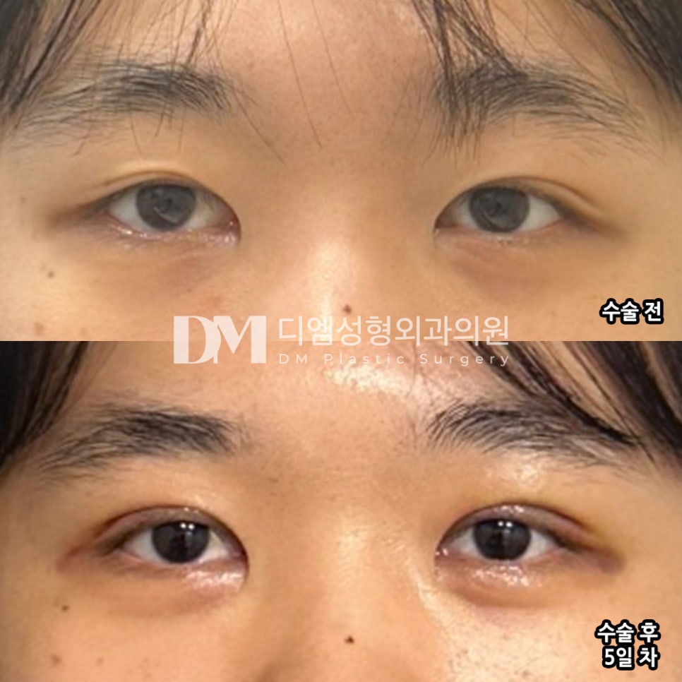Double Eyelid Revision Surgery Review. "I was surprised that there wasn’t much swelling!" image 2