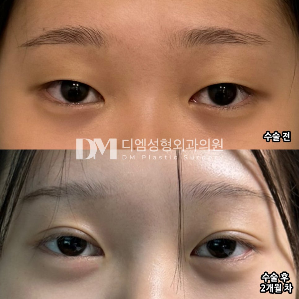 눈성형 후기."친구들이 눈 이쁘대요!" 관련 이미지 2