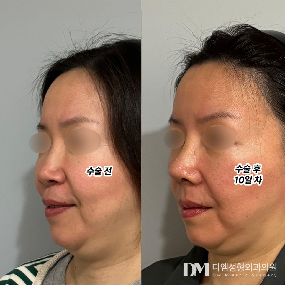 Rhinoplasty Review. "I heard praise that the surgery was a success, and I’m very happy with it!" image 2