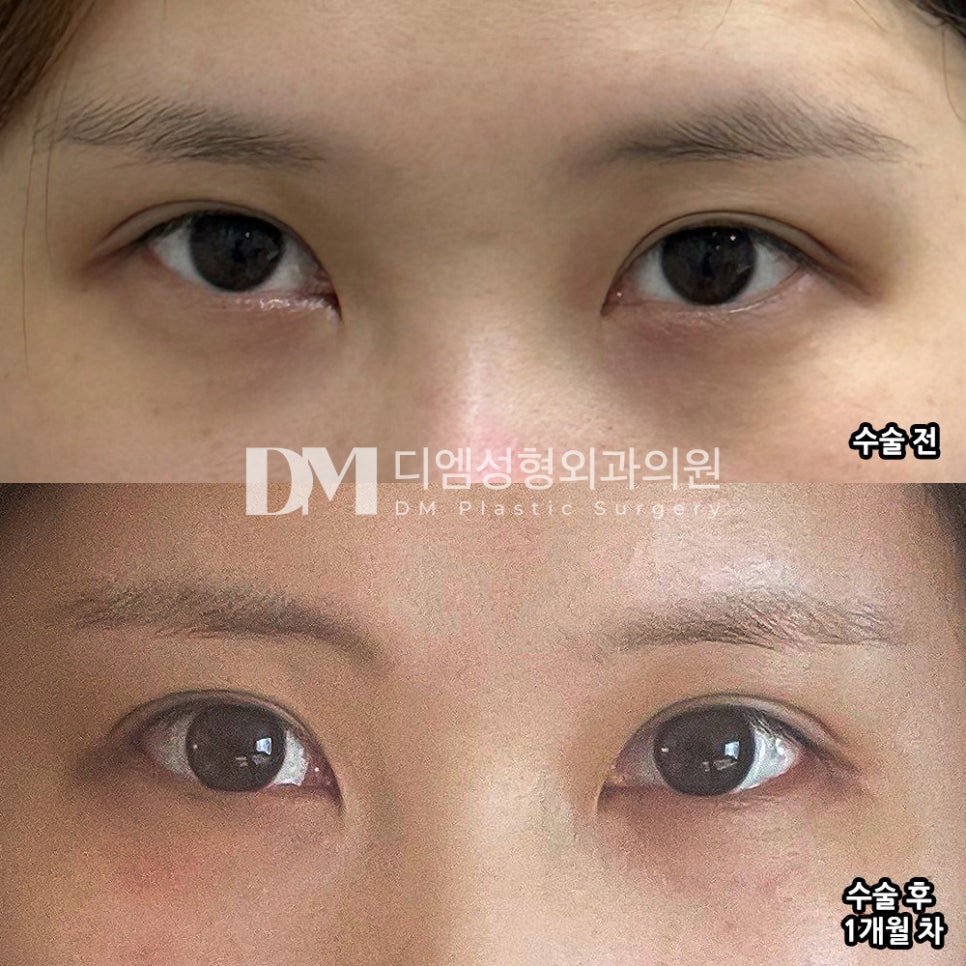 Canthoplasty Review. “Recommended for Those Who Want a Naturally Open, Beautiful Eye Shape!” image 2