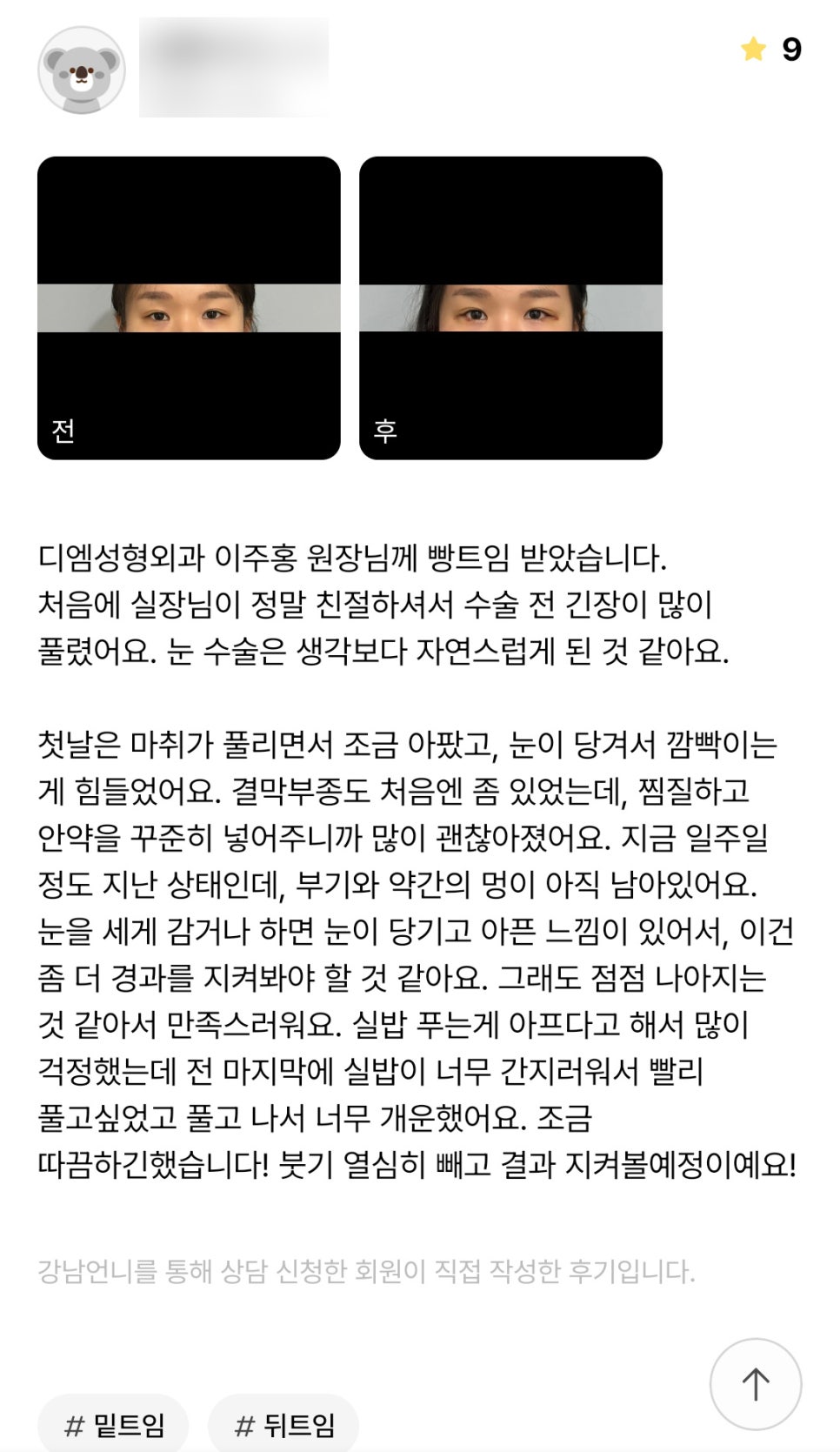 빵트임 후기."눈 수술은 생각보다 자연스럽게 된 것 같아요!" 관련 이미지 1