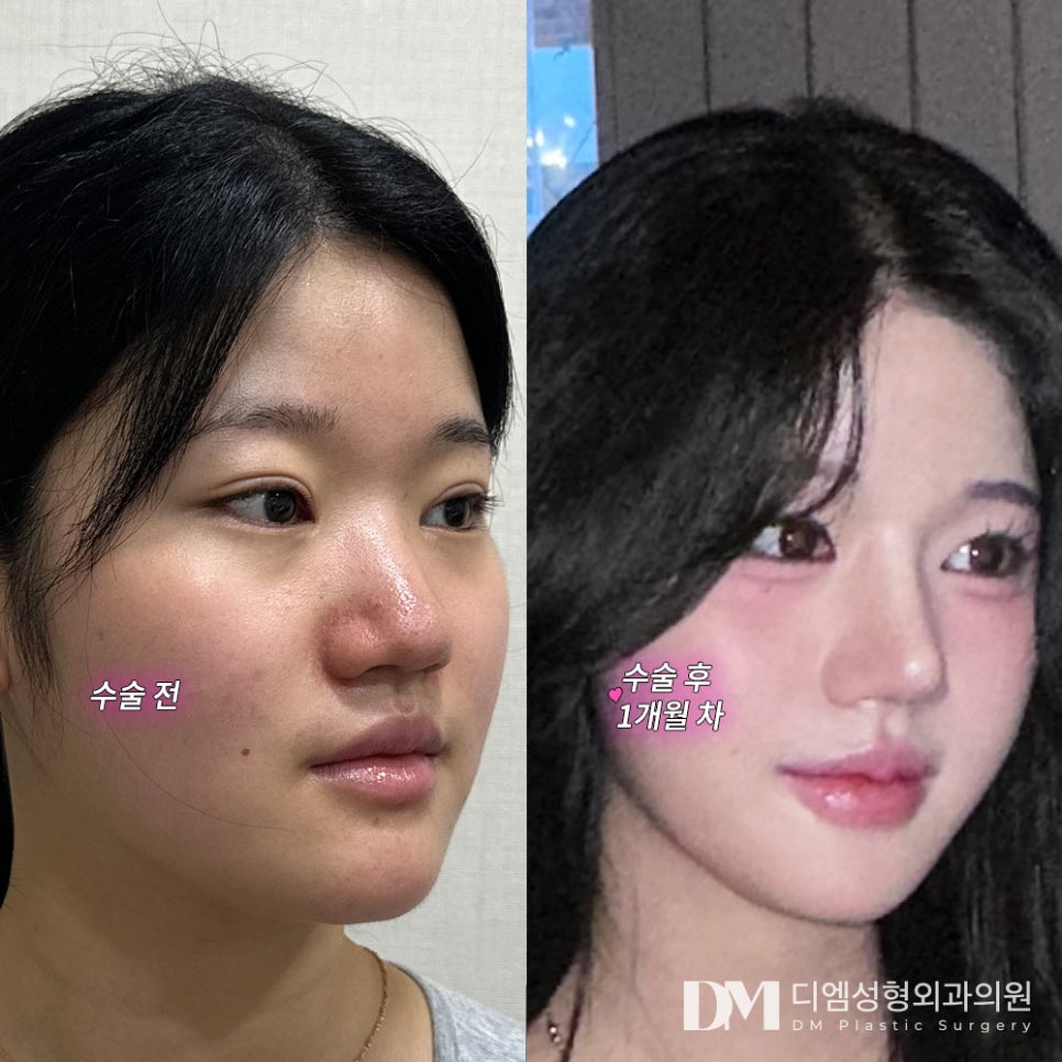 Rhinoplasty Revision Review. "I’m more satisfied than I expected!" image 2