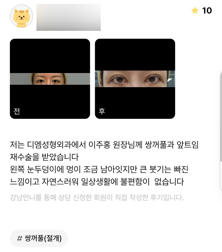 눈성형 후기."자연스러워서 일상생활에 전혀 불편함이 없어요!" 관련 이미지 1
