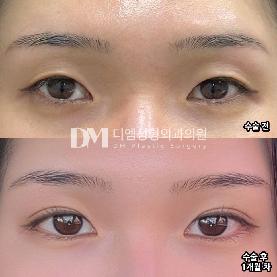디엠 눈매교정/뒤밑트임 후기, &ldquo;다들 눈매가 선하고 초롱초롱해졌다고 놀라요!&rdquo; 관련 이미지 2