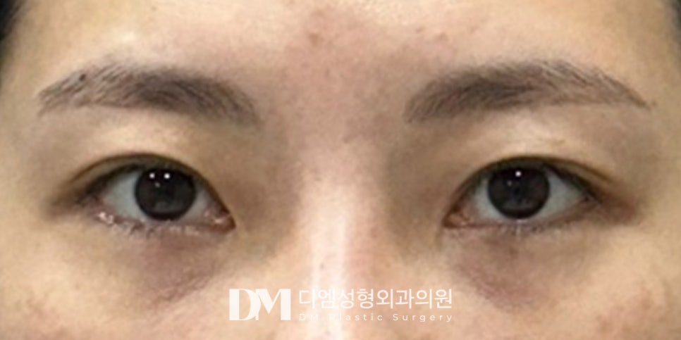 Want to Look Naturally More Beautiful with Double-Eyelid Surgery for the New Year? image 7