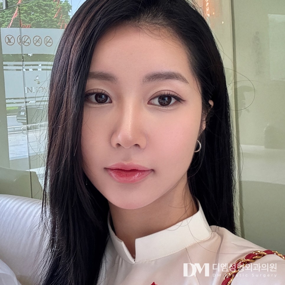 쌍꺼풀수술, 맞춤형 플랜으로 더욱 자연스럽게 관련 이미지 1