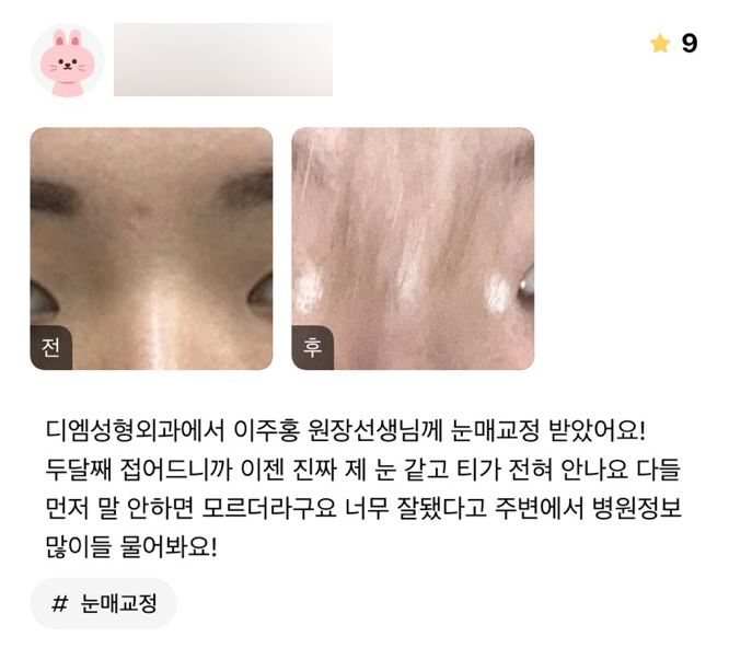 Double Eyelid Surgery Review: “Now They Really Look Like My Own Eyes, and You Can’t Tell at All!” image 1