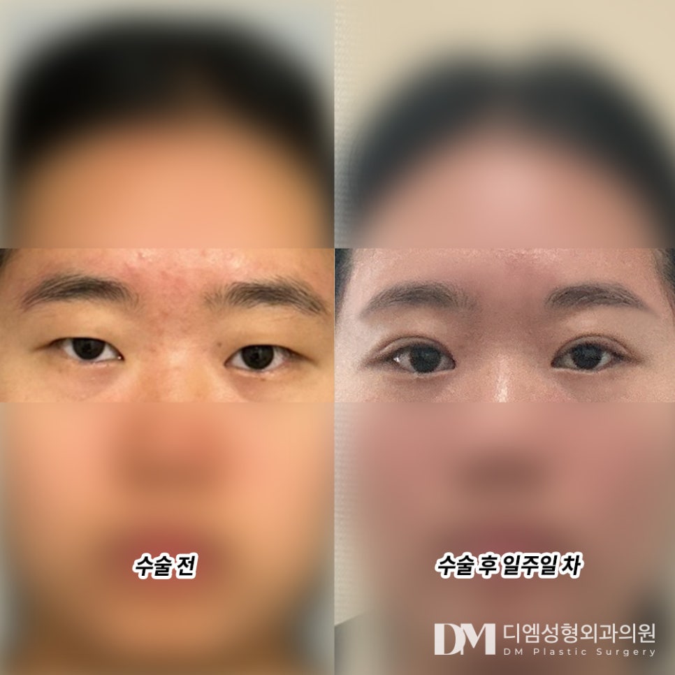 눈성형 후기."전반적으로 친절한 직원,시설 ,특히 결과물 등 모든것이 마음에 들었습니다." 관련 이미지 2