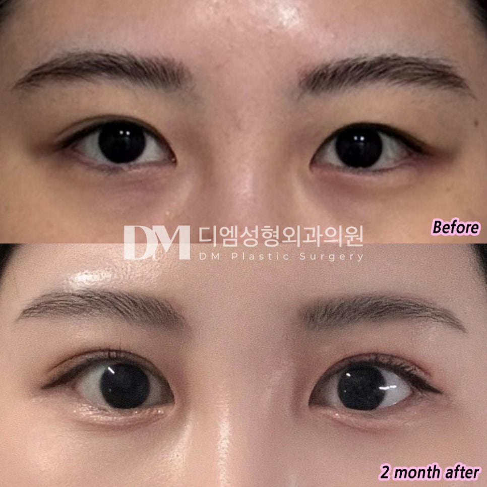 Review of Revision Eye Surgery. “My eyes became naturally more defined!” image 2
