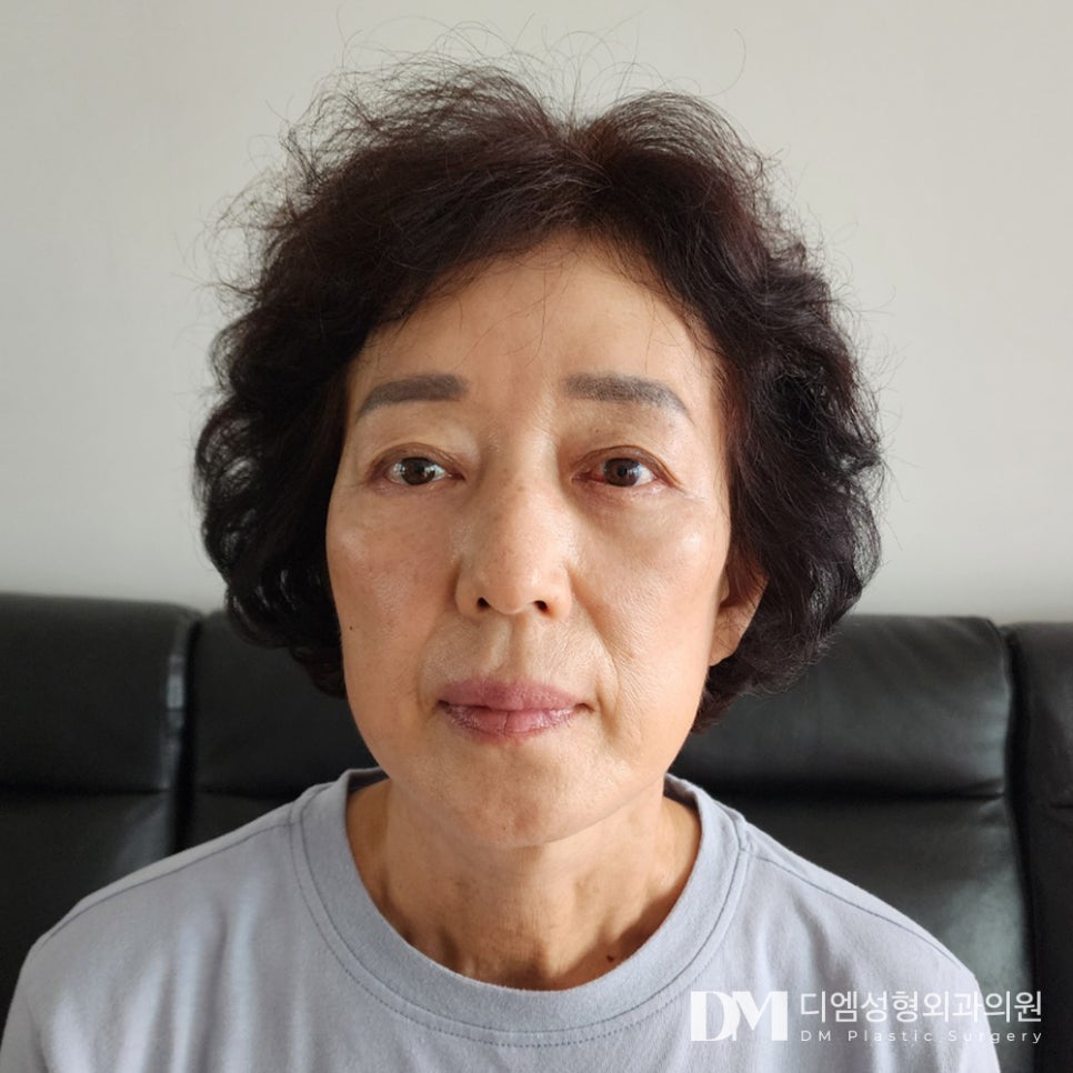 노화로 인한 불룩한 눈밑, 하안검으로 ! 관련 이미지 1