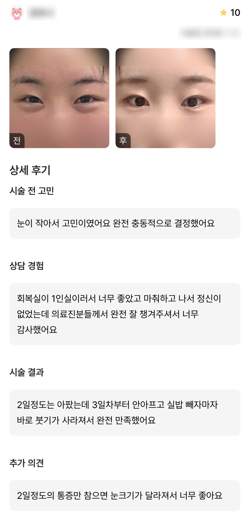 디엠 빵트임 수술후기, &ldquo;눈 크기가 달라져서 너무 좋아요!&rdquo; 관련 이미지 1