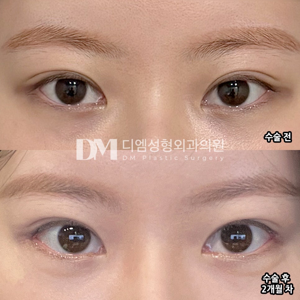 디엠 뒤밑트임 수술후기, “인상이 훨씬 부드러워 보여서 너무 만족스러워요!” 관련 이미지 2