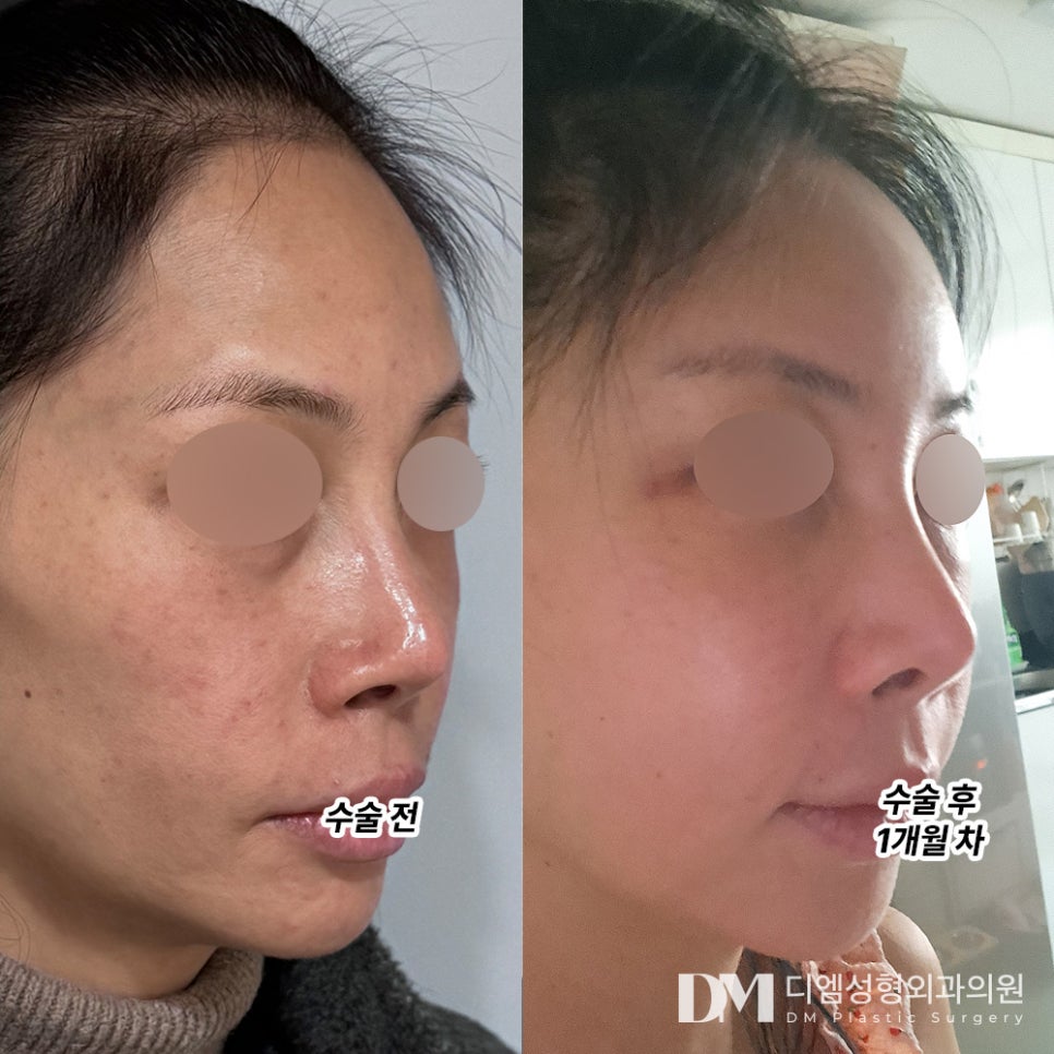 얼굴지방이식 후기."붓기가 덜 빠졌지만 너무나 만족합니다 원장님 복받으세요 감사합니다!" 관련 이미지 2