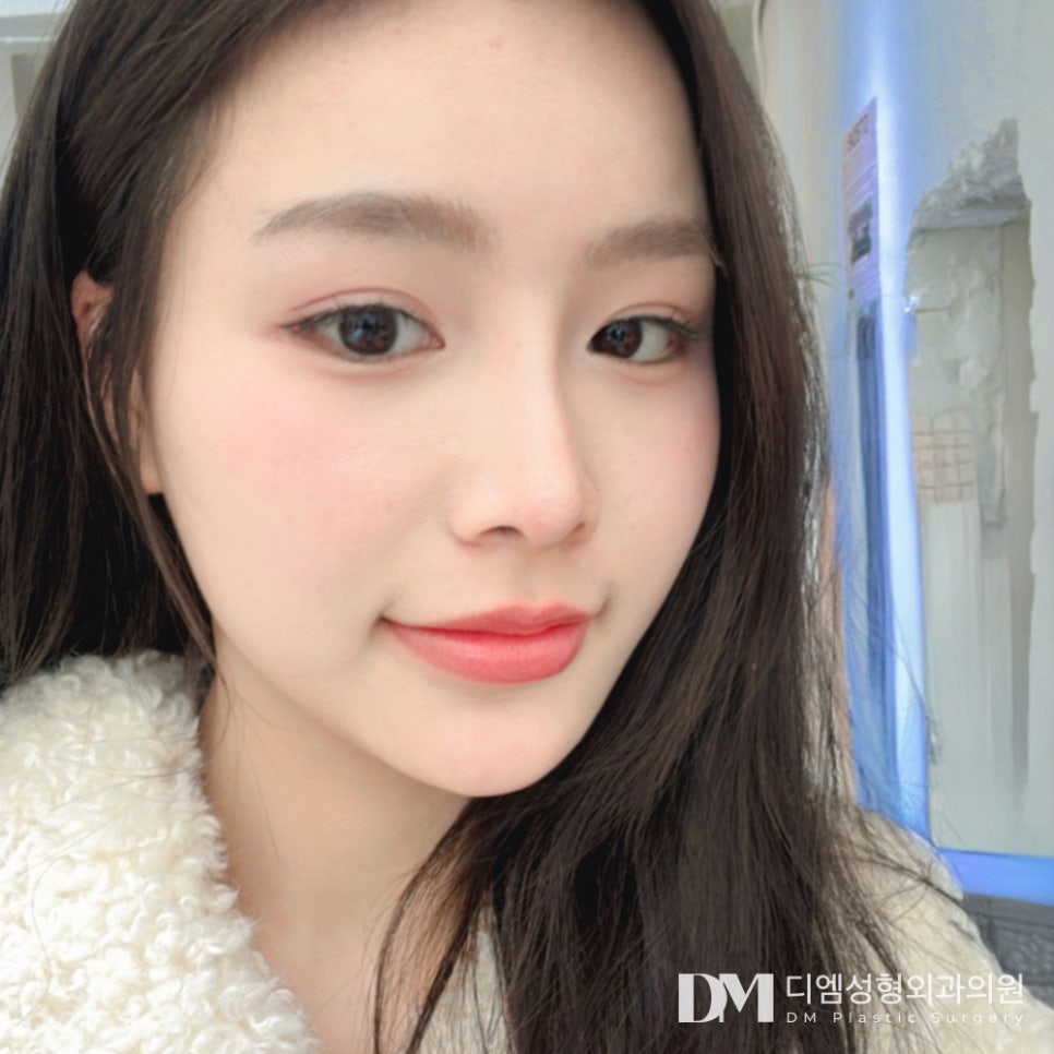 뒤밑트임, 짧아 답답해보이는 눈매라면? 관련 이미지 9
