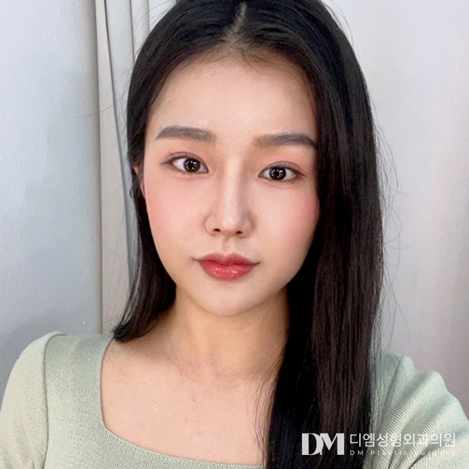 DM Under-Eye Fat Repositioning Before-and-After Photos: How Can Bulging and Dark Under-Eyes Be Improved? image 1