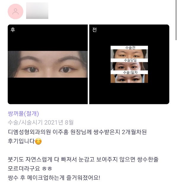 Review of Eye Surgery. "I’ve Started Enjoying Makeup!" image 1