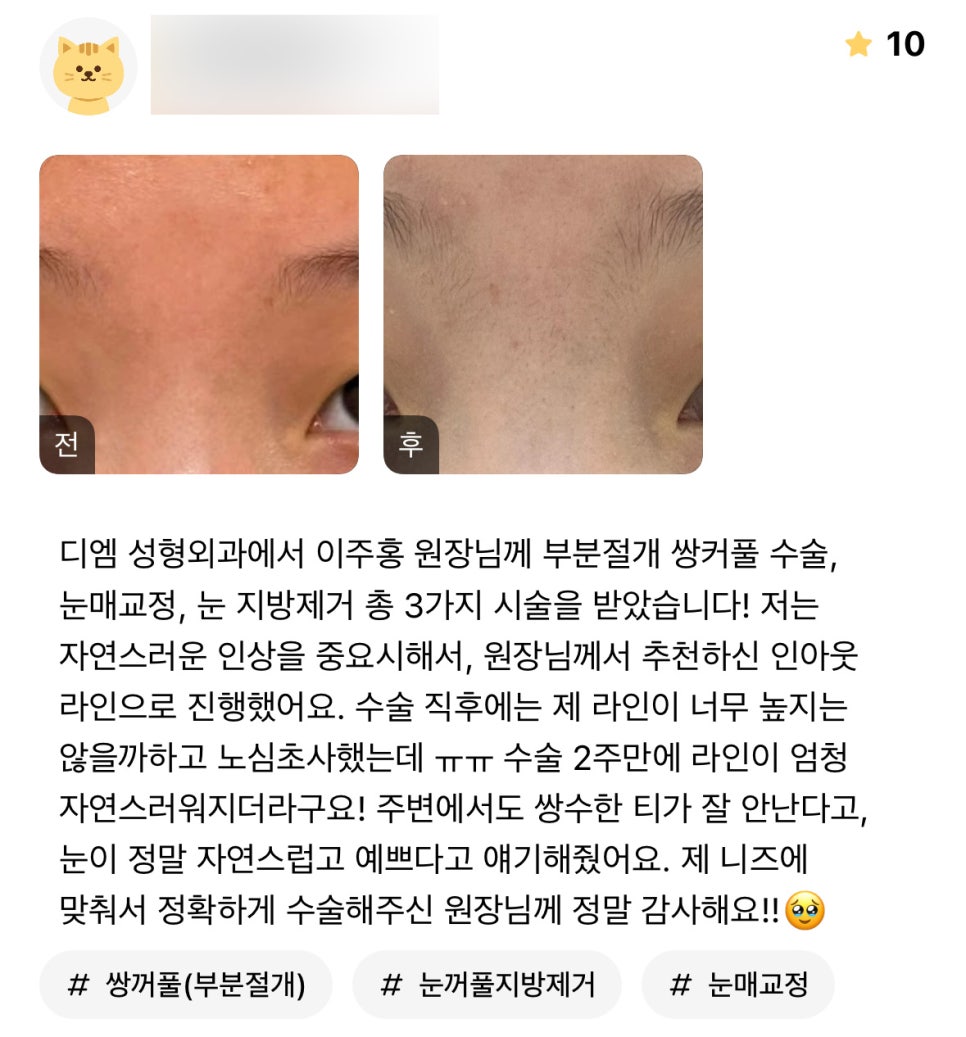 Double-Eyelid Surgery Review: “I’m truly grateful to the director for performing the surgery precisely according to my needs!!” image 1