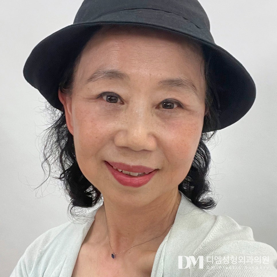 상안검, 처져 답답해 보이는 눈매 개선하기 관련 이미지 1