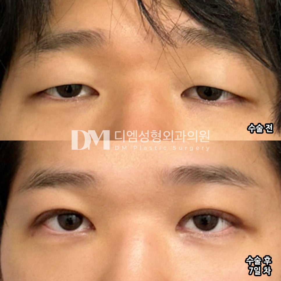 Eye Plastic Surgery Review: “Even before the swelling has gone down, it looks so natural that I can only think I made the right decision!” image 2