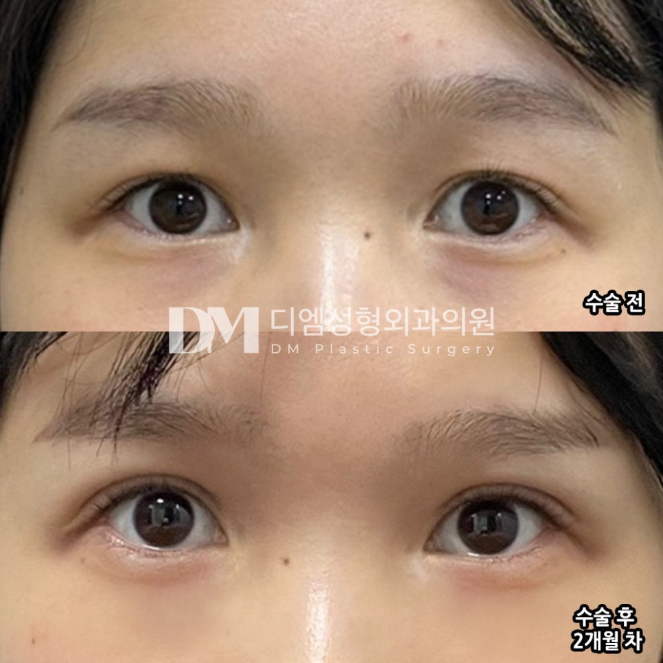 Double Eyelid Revision Review: “I Want to See My Eyes Settled Quickly!” image 2