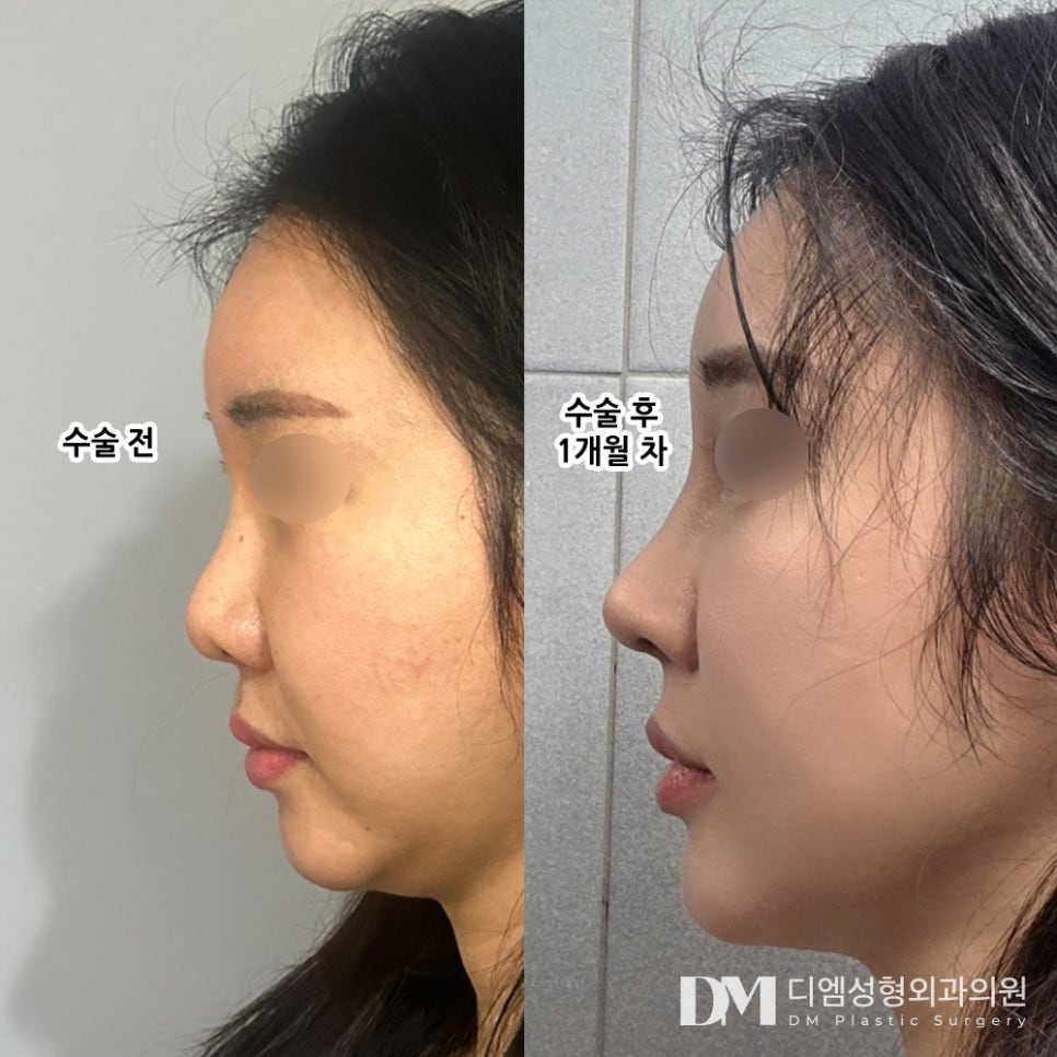Revision Rhinoplasty: Proceed More Carefully Than with the First Surgery image 10