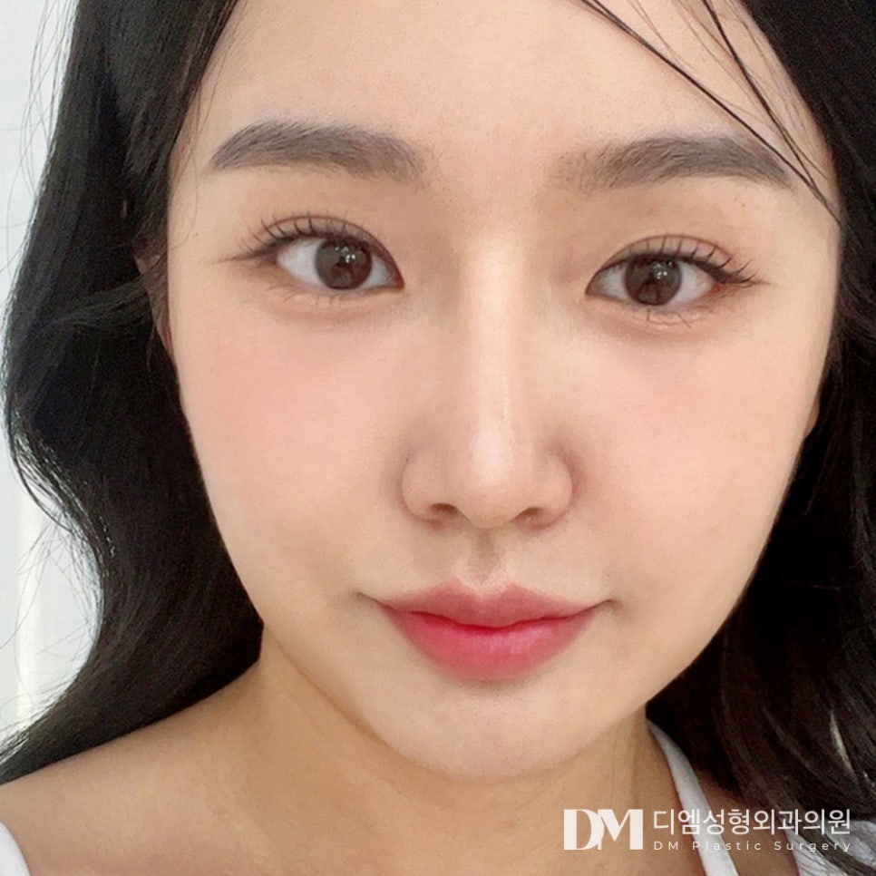 Under-Eye Fat Repositioning for a Brighter, More Refreshed Look image 10