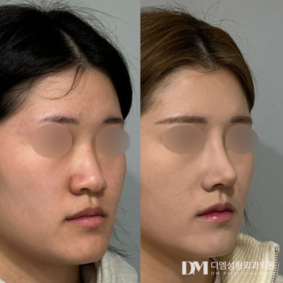 Is a Broad, Bulbous Nose Causing You Stress? image 9
