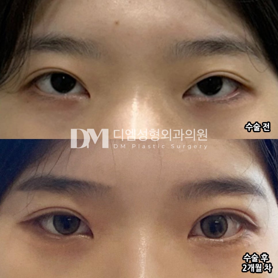 눈재수술 후기."자세한 상담이 좋았고 결과도 만족합니다!" 관련 이미지 2