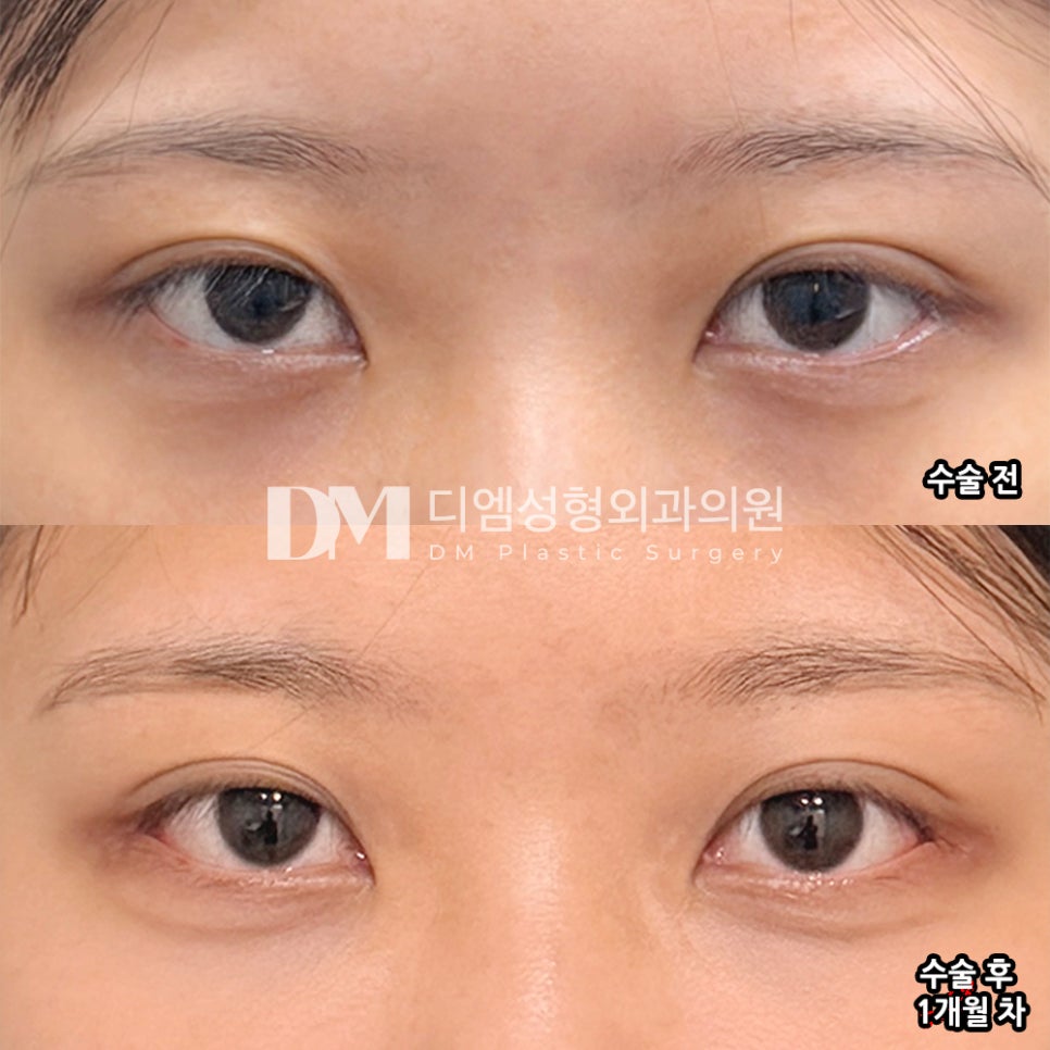 디엠 뒤밑트임 전후사진, 선하고 시원해진 눈매의 비결은? 관련 이미지 2