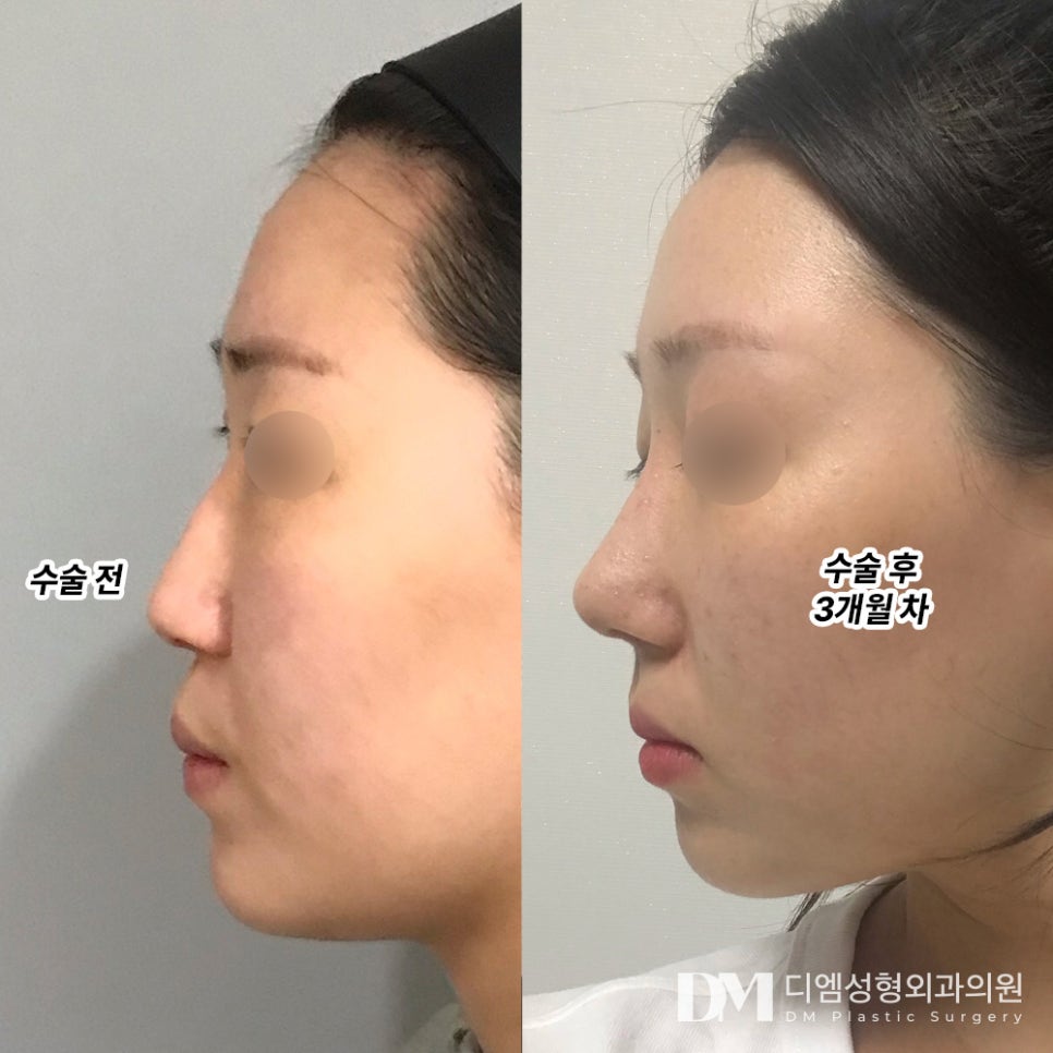 코성형 후기."부자연스러운 느낌없이 자연스럽게 휜 코가 교정이 되어서 좋습니다!" 관련 이미지 2