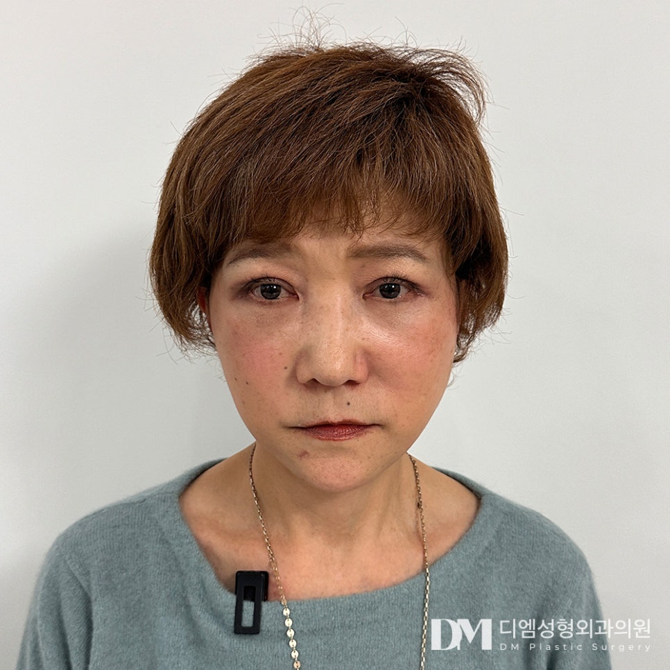 Lower Eyelid Surgery: Improve Under-Eye Aging and Transform Your Look for a More Youthful Appearance! image 1