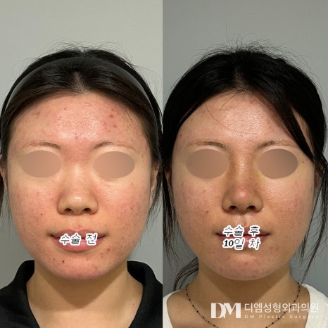 코성형 후기."콧대,코끝, 전체 밸런스까지 세심하게 봐주시고 코 전문으로 하셔서 그런지 믿음이 확 갔어요." 관련 이미지 2