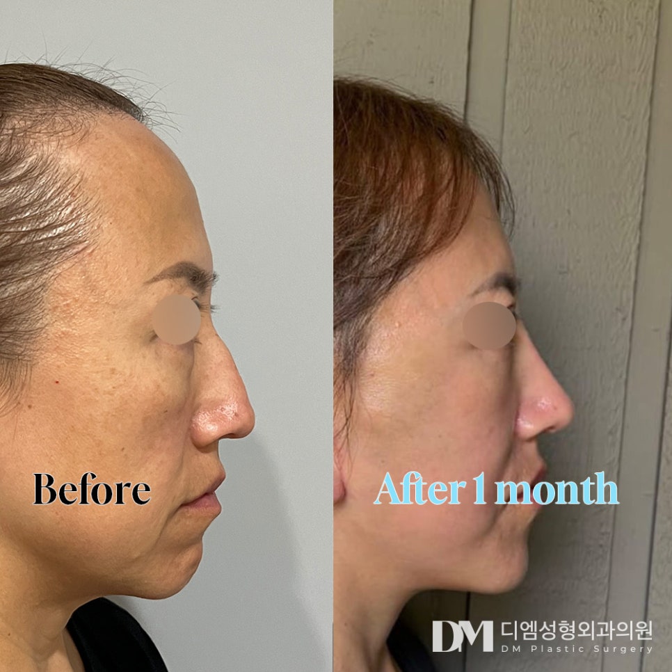 매부리코, 굴곡진 콧대가 고민이라면 관련 이미지 6