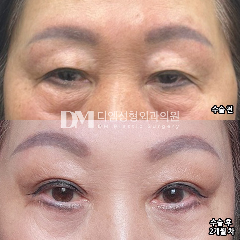 상안검,눈이 자꾸 처져 시야를 가린다면? 관련 이미지 11